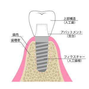 木更津市清見台の歯医者・歯科医院、清見台いしい歯科では、すべてのインプラント治療をインプラント専修医が担当し、質の高いインプラント治療を提供しています。