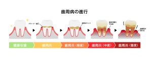 木更津市清見台の歯科医院、清見台いしい歯科では、お一人おひとりの歯周病の進行度合いに合わせて、歯周基本治療や外科治療など、最適な歯周病治療をご提案いたします。