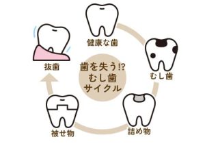 木更津市清見台の歯医者・歯科医院、清見台いしい歯科では、なるべく健康な歯を残すむし歯治療で、未来のお口の健康を考えていきます。